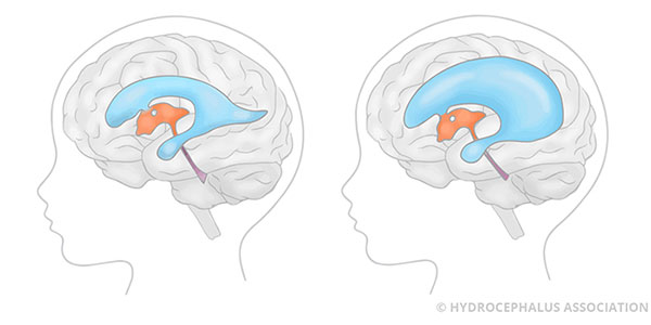 Hydrocephalus Ventricles Normal Enlarged Side View