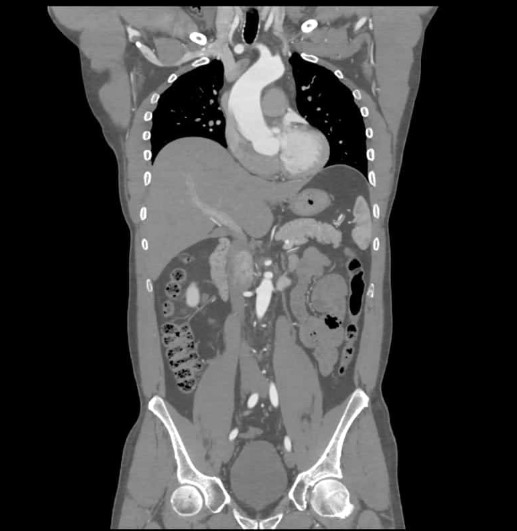 Abd CT scan