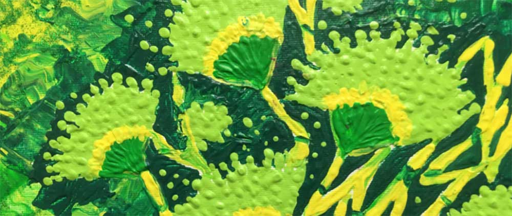 Aspergillus by Ana P. Valdez, MD