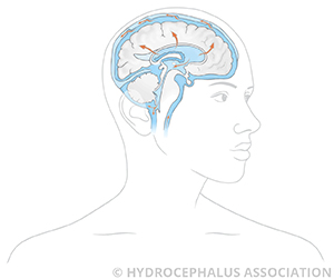 Hydrocephalus HACSF Flow Adult Female