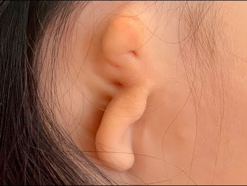 Microtia patient