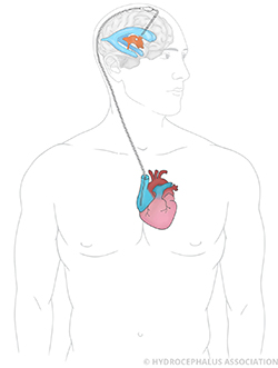 Hydrocephalus HAVA Shunt Adult Male