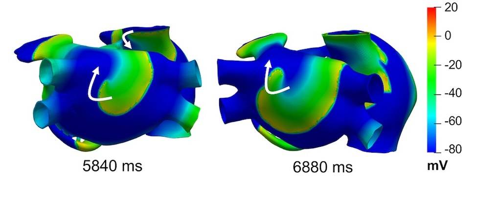 Simulation of electrical conduction in a human heart undergoing atrial fibrillation (AF)