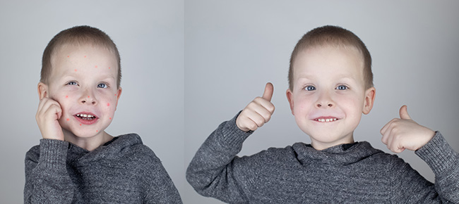 Pediatric Dermatology